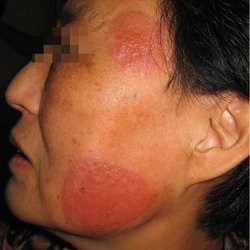 牛皮癣易与哪些皮肤病相似