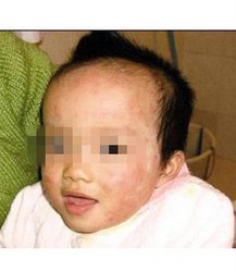 冬季怎样预防小儿牛皮癣